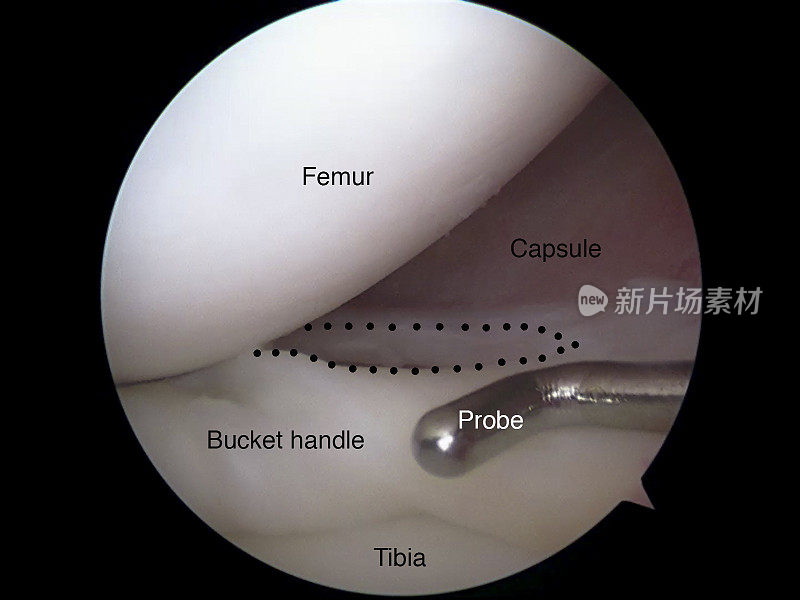 内侧半月板桶柄撕裂的关节镜观察
