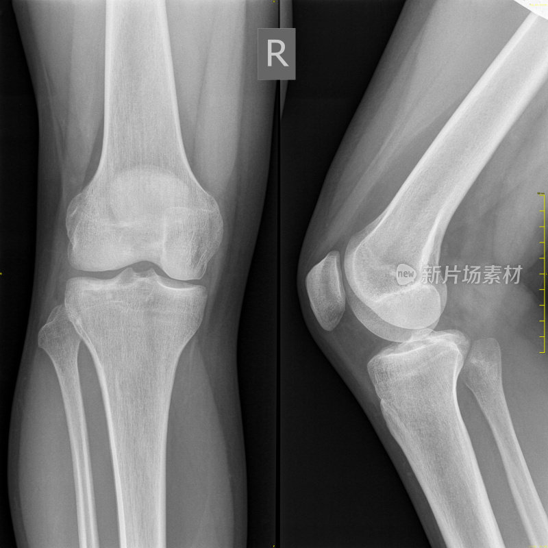 医用x光正常膝骨，高解析度影像
