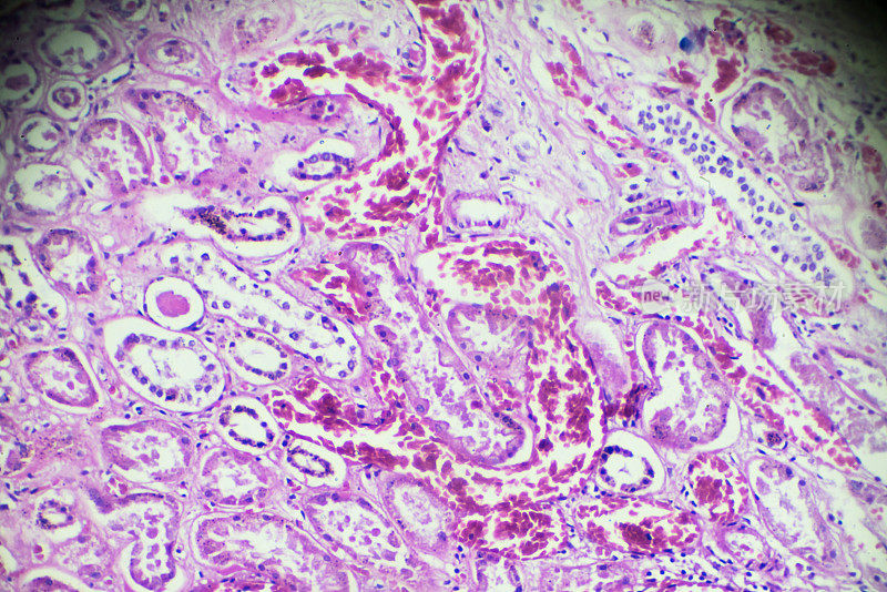 显微镜下急性肾炎活检标本