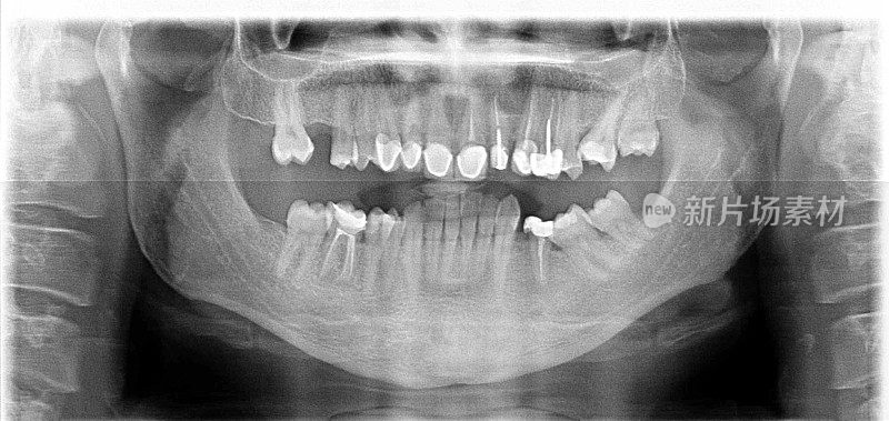 牙科x光片
