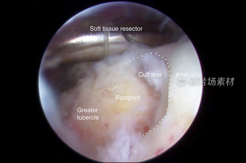 肩关节镜下观察肩袖撕裂
