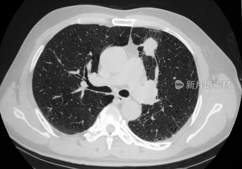 肺癌胸部CT图像