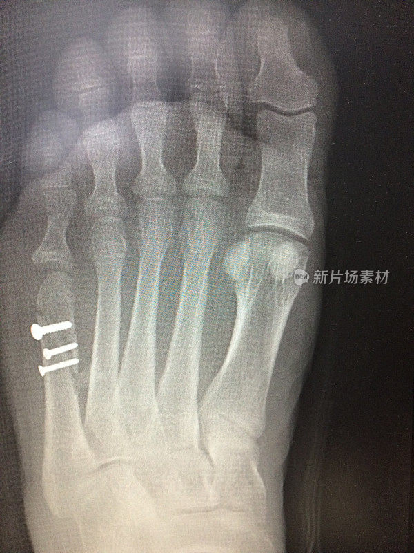 足部骨折固定x线照片，AP视图