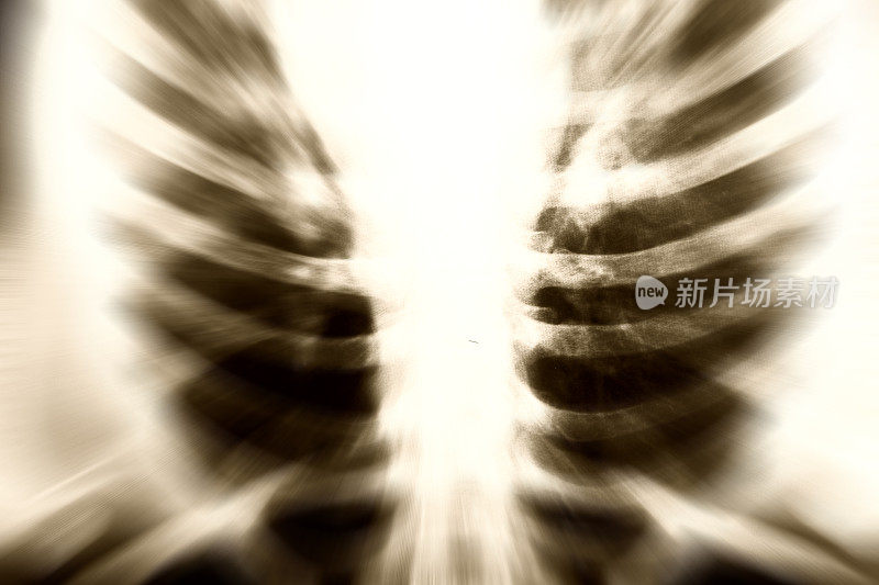 胸部X光片