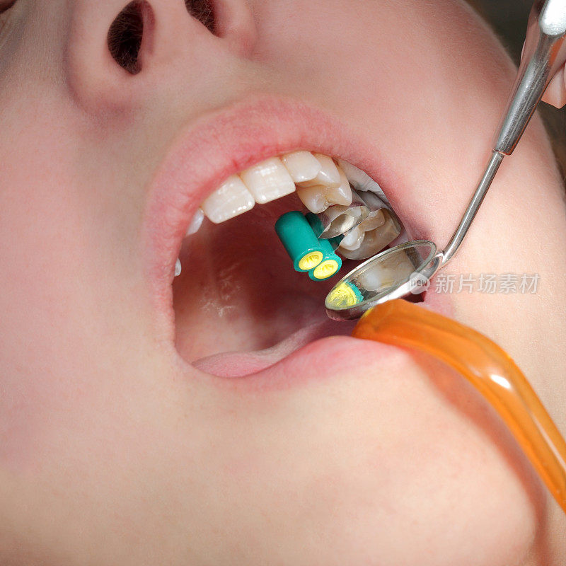 牙科治疗，补牙