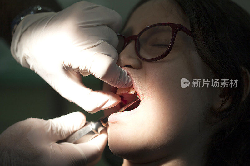 牙科Patient-tooth提取