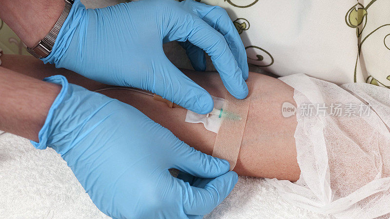 护士从病人手臂上的静脉输液中固定导管。