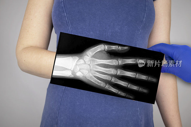 一个女人手腕的x光片。把手指和手的照片放在病人的手上。放射科医生检查x光片。