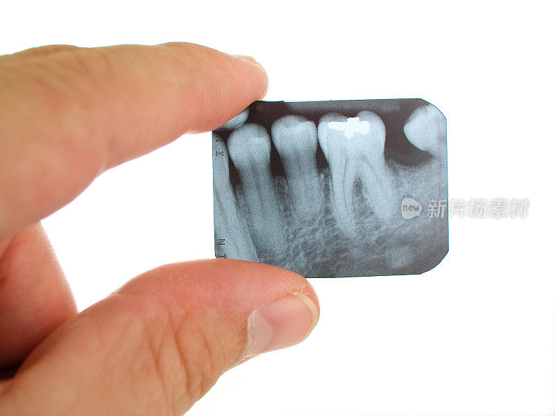 一只手拿着一张小小的牙科x光片