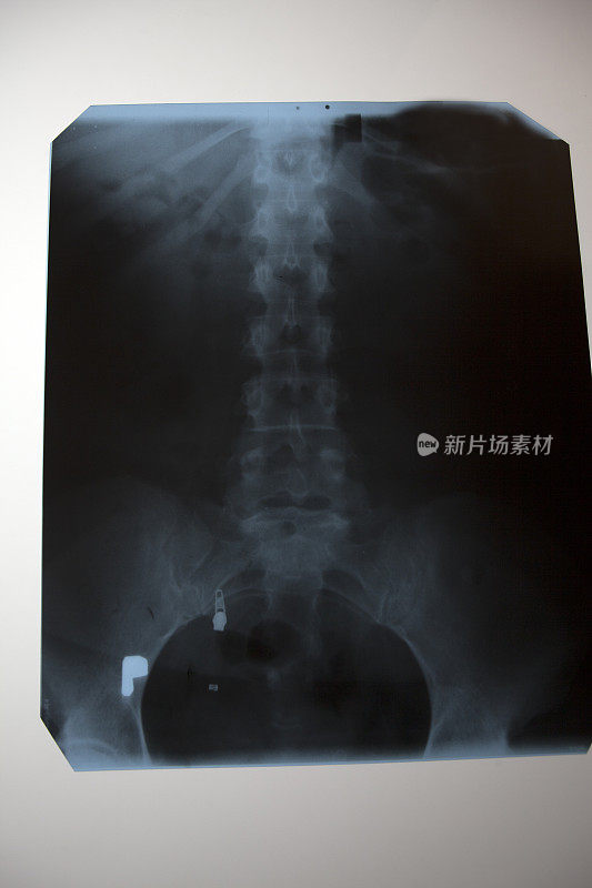 脊椎和骨盆x光片