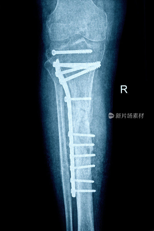 骨折腿的x线照片与骨合成材料