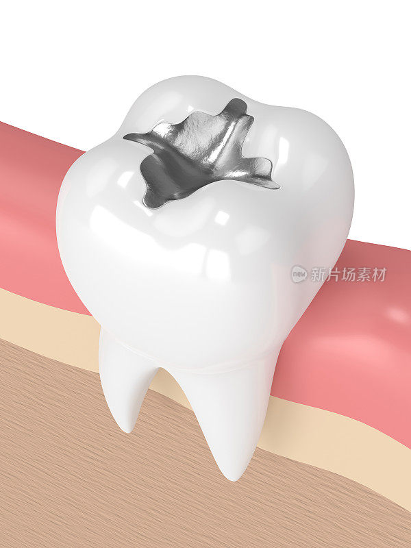 牙齿的3d渲染与牙科汞合金填充