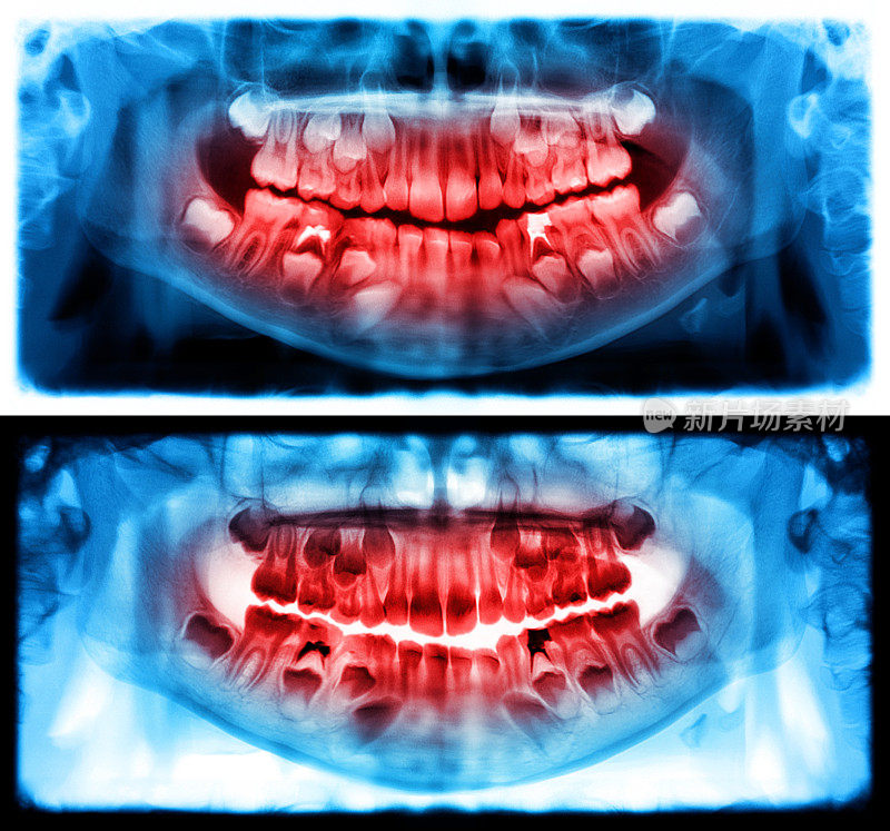 全景x光片是一种上下颌的全景扫描牙科x光片。这是焦平面断层扫描显示的是一个七岁小孩的上颌骨和下颌骨。