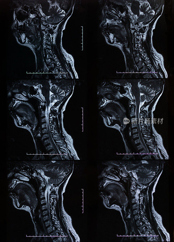 核磁共振扫描人类头颈部胶片