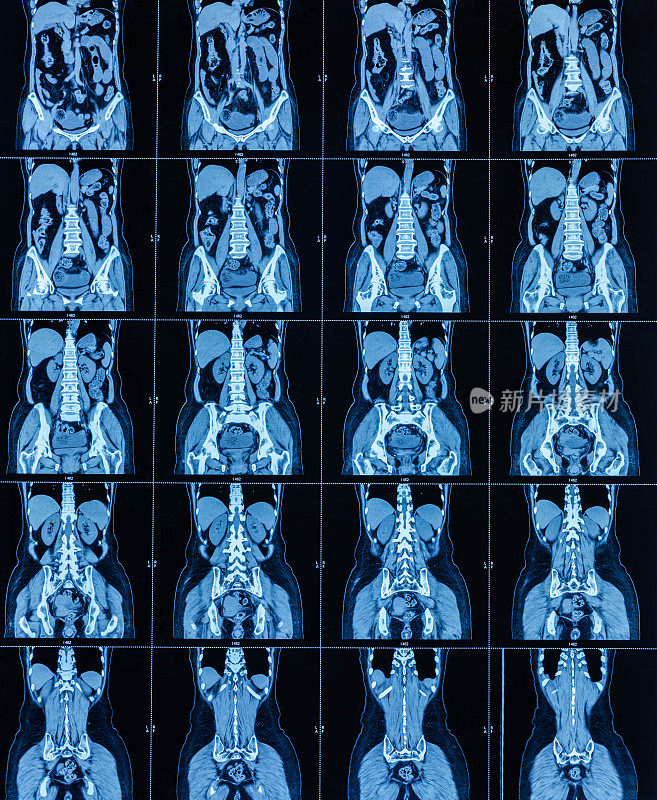 MRI扫描人体腹部断层扫描