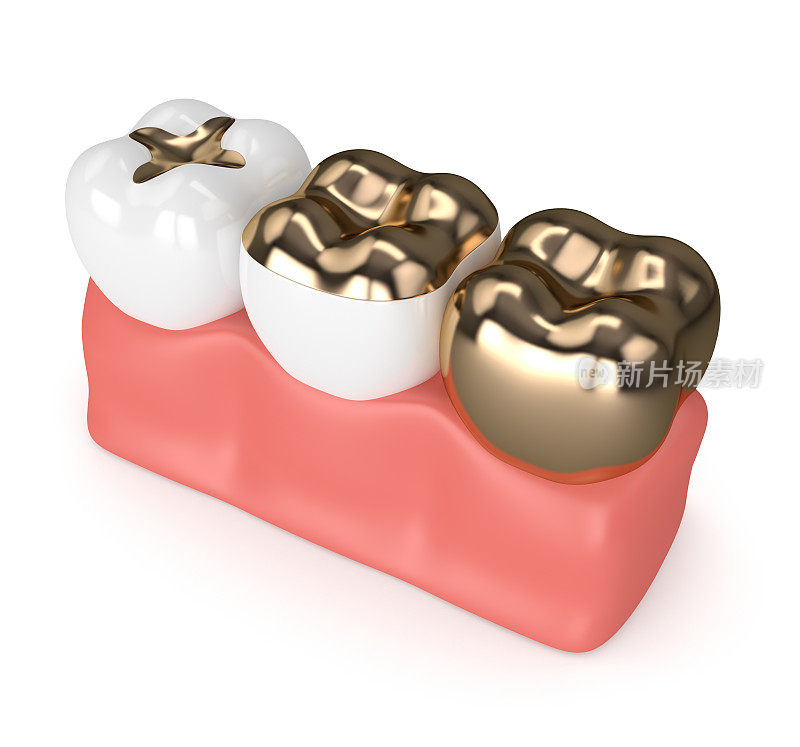牙齿的黄金充填物的3d渲染