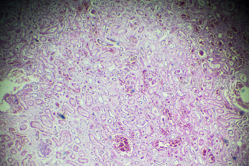 显微镜下急性肾炎活检标本