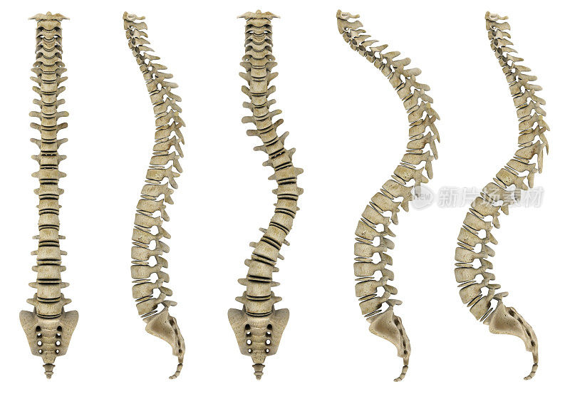 人类骨骼显示出脊椎问题