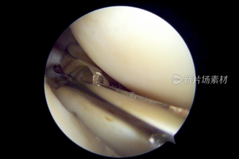 右膝急性创伤性半月板撕裂患者的内侧半月板部分切除术