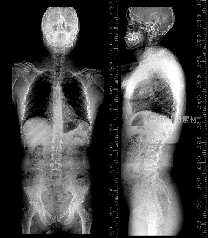 整个人体脊柱的x线图像比较正位和侧位显示胸椎侧凸