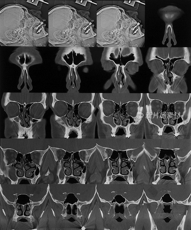 鼻窦ct扫描