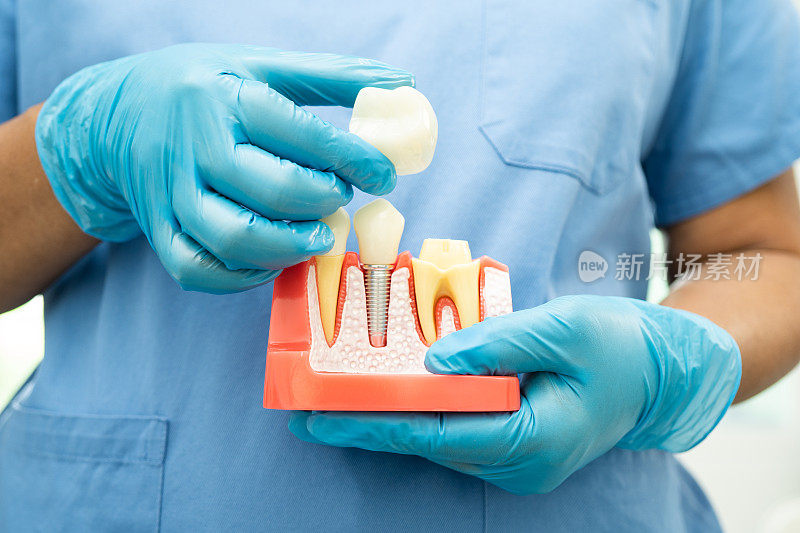 种植牙，下颌人工牙根，牙根管治疗，牙龈疾病，牙科研究用牙模型。