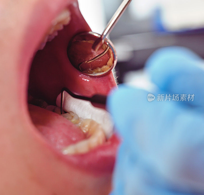 牙医检查病人的口腔