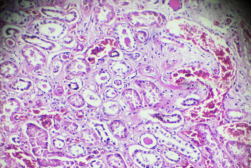 显微镜下急性肾炎活检标本