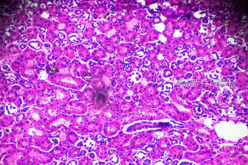显微镜下急性肾盂肾炎活检标本