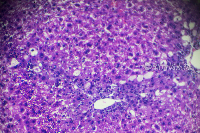光镜下急性普通肝炎肝活检