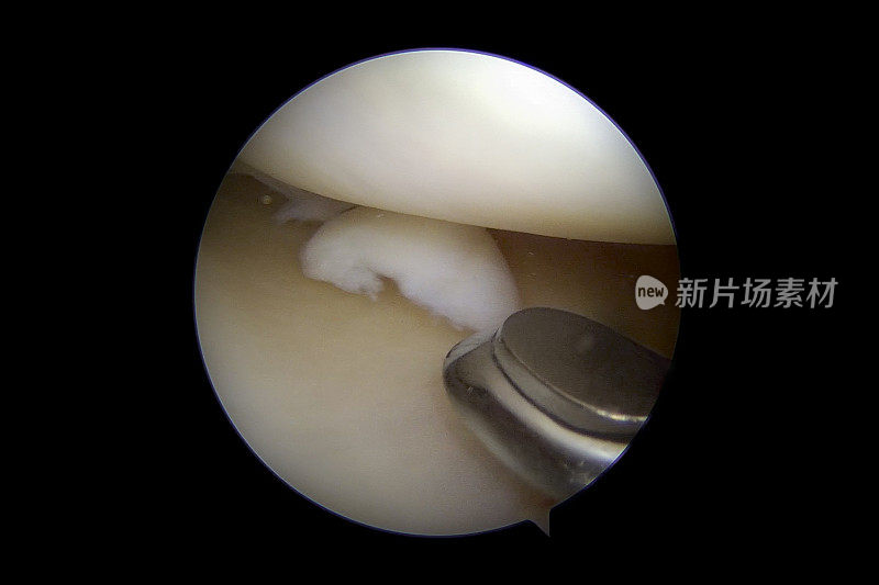 右膝关节内侧室半月板撕裂的关节镜照片
