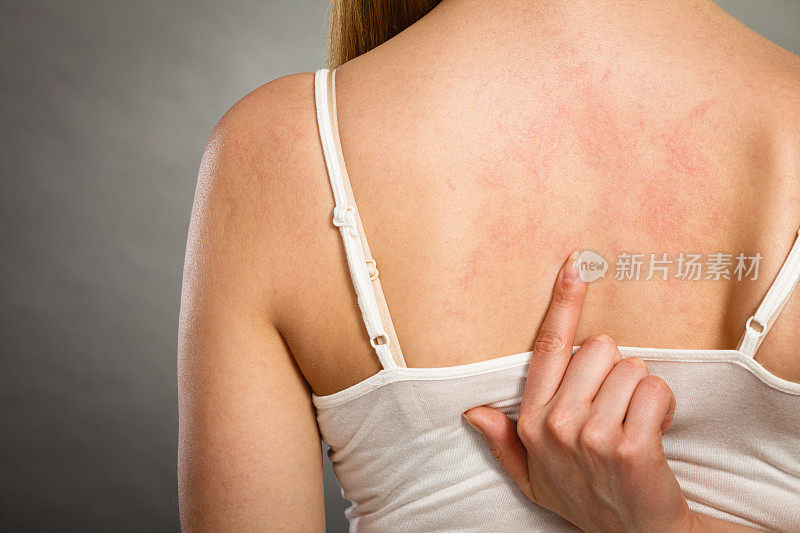 一个女人用过敏皮疹挠着她发痒的后背