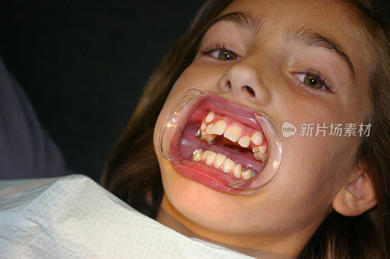 年轻女孩在牙齿矫正-特写