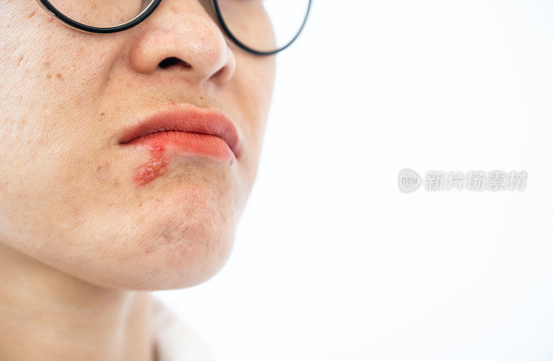 女性下唇疱疹，有孤立复制空间。水泡破裂形成小溃疡，淋巴结肿大。