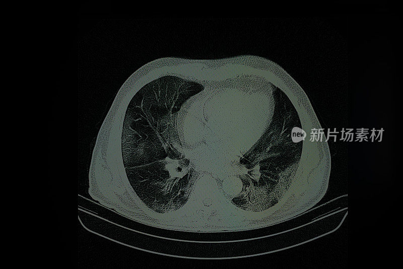 计算机显示器上的人肺胸部Ct图像