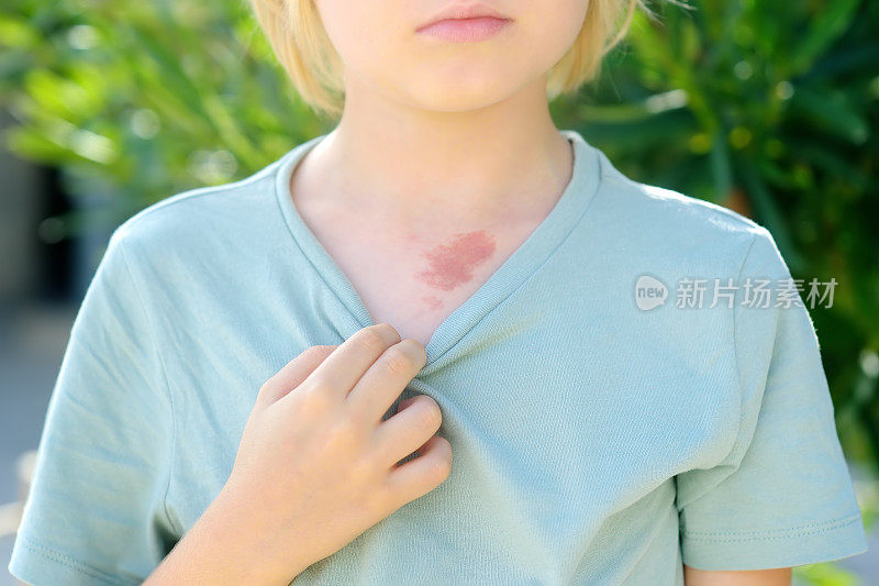 八岁儿童胸部皮肤上的记号。血管瘤是皮肤血管上的红色胎记，良性肿瘤。
