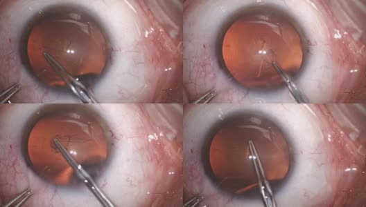 白内障眼科手术高清在线视频素材下载