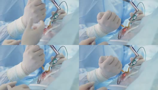 一个助手在眼部手术中使用注射器的手的特写。高清在线视频素材下载