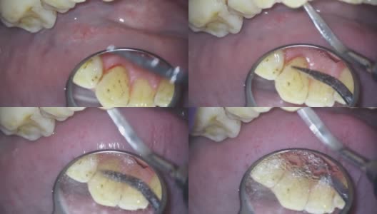 牙医。用显微镜拍摄。牙科治疗。用镜子检查牙齿的内表面高清在线视频素材下载