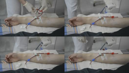护士准备病人的手臂进行透析高清在线视频素材下载