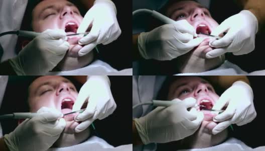 牙科医生在牙齿上钻孔时按住病人的下巴高清在线视频素材下载