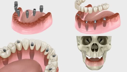 下颌骨假体全部在4个系统上，由种植体、螺钉固定。医学上精确的3D动画牙科概念高清在线视频素材下载