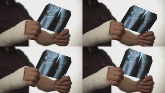 一名右手骨折的男子看着仁根的照片。手骨折导致残疾。健康保险。特写镜头高清在线视频素材下载