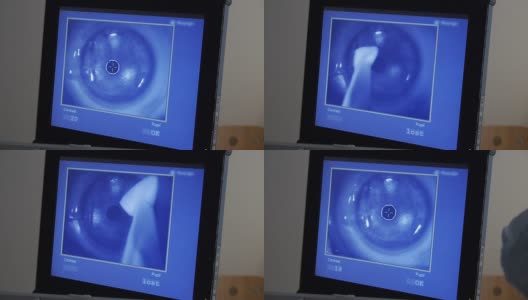 MACRO:激光眼科手术，第5步高清在线视频素材下载