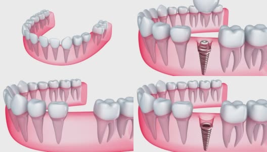 植入物嵌在牙龈中高清在线视频素材下载