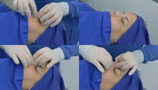 外科医生完成女性患者鼻中隔偏曲鼻整形手术后。高清在线视频素材下载