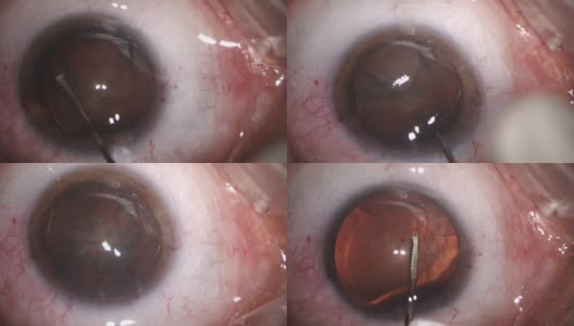 白内障眼科手术高清在线视频素材下载