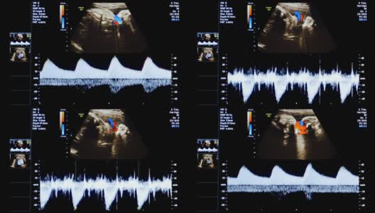 HD -医疗超声扫描。心率诊断高清在线视频素材下载