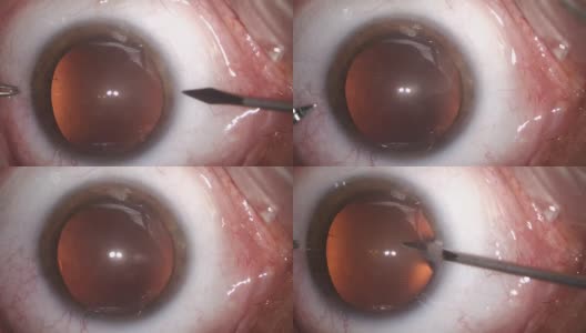 白内障眼科手术高清在线视频素材下载