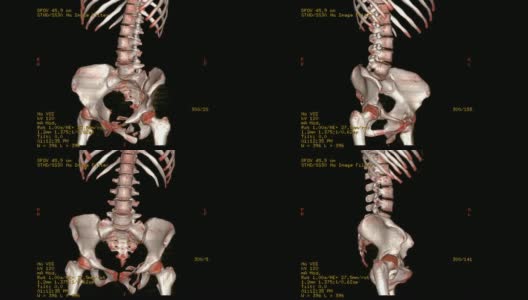 腰椎CT扫描图像渲染图像。在监视器上旋转。高清在线视频素材下载